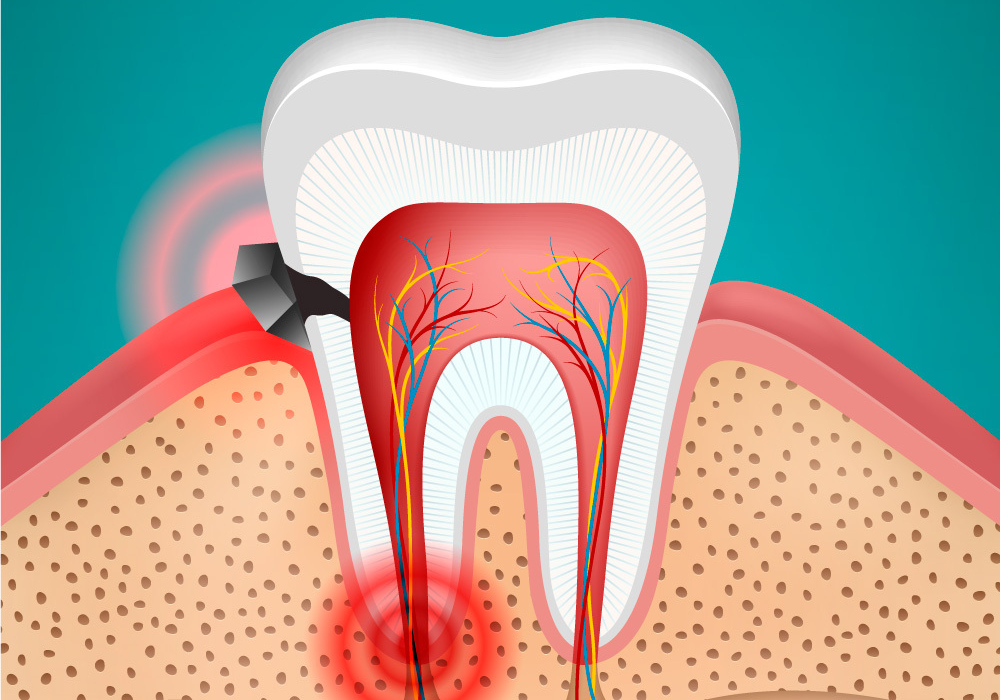 toothache Webster Groves, MO - toothache dental treatment in Webster Groves, MO