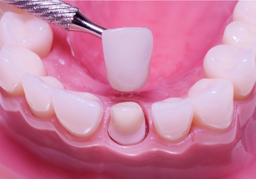 dental restoration Kirkwood, MO | Kirkwood, MO restorative dentistry | Plaza Dental Center