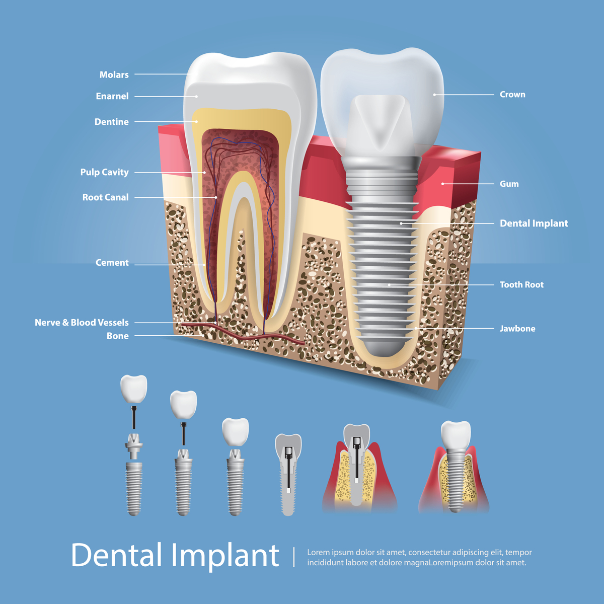 Dental Implant Shrewsbury, MO | Tooth Pain | Restorative Dentistry | Cosmetic Dentistry Near Shrewsbury, MO
