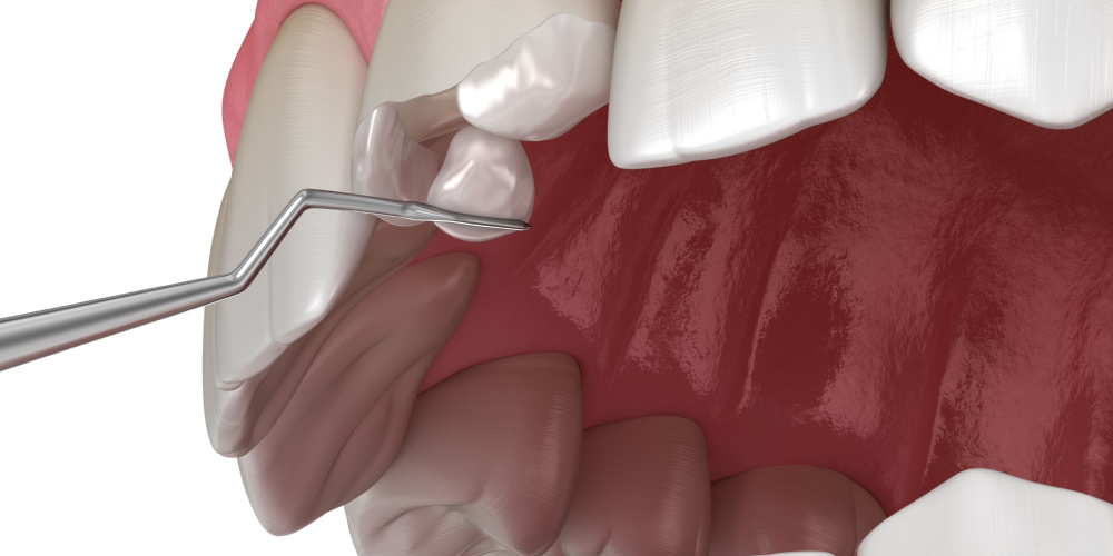 Composite Fillings in Crestwood, MO | Cosmetic and Restorative Dentistry Near Crestwood