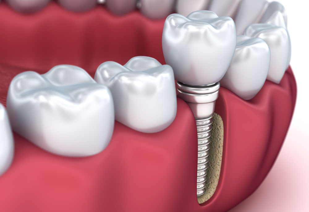 Dental Implants St. Louis | Restorative Dentistry Dentistry | Cosmetic Dentistry Near Me