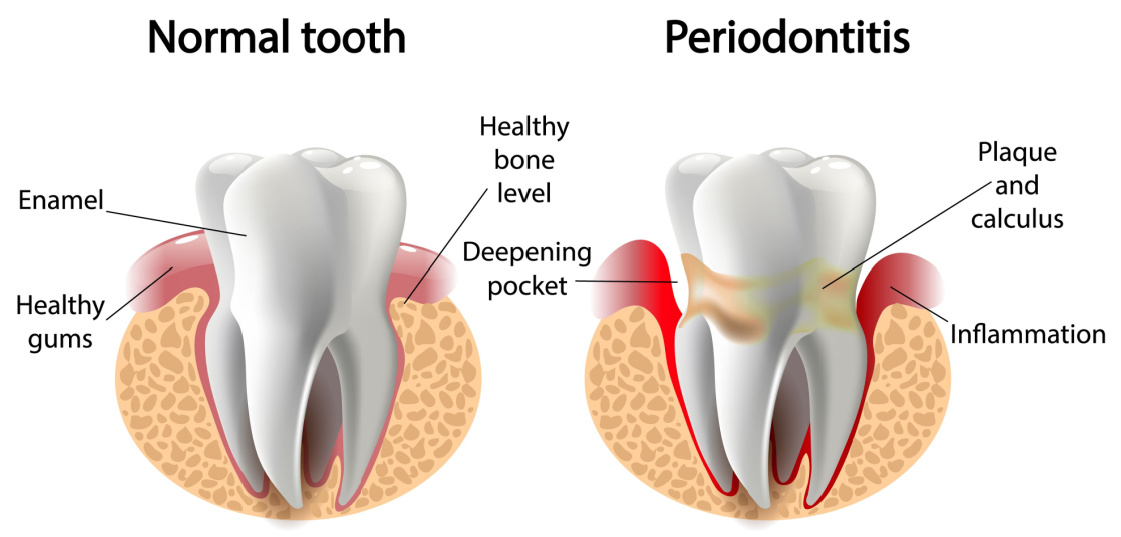 Periodontal Treatment St. Louis | Gingivitis Treatment | Dental Office Near St. Louis