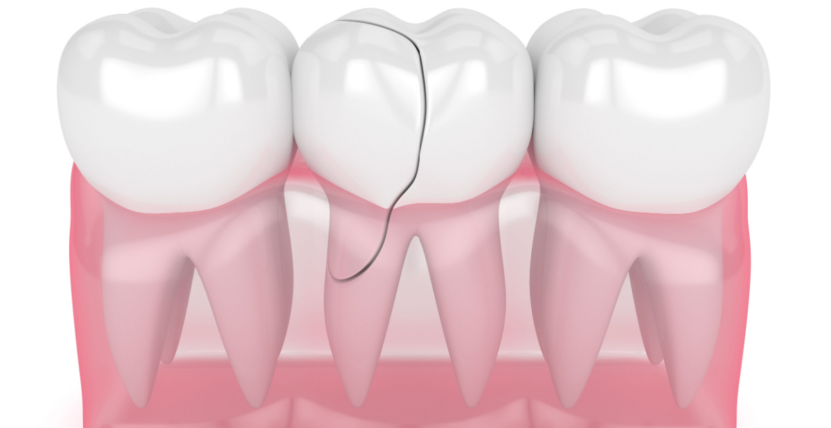 Broken Tooth Repair St. Louis | Dental Bonding and Crowns | Cosmetic Dentistry Near Me