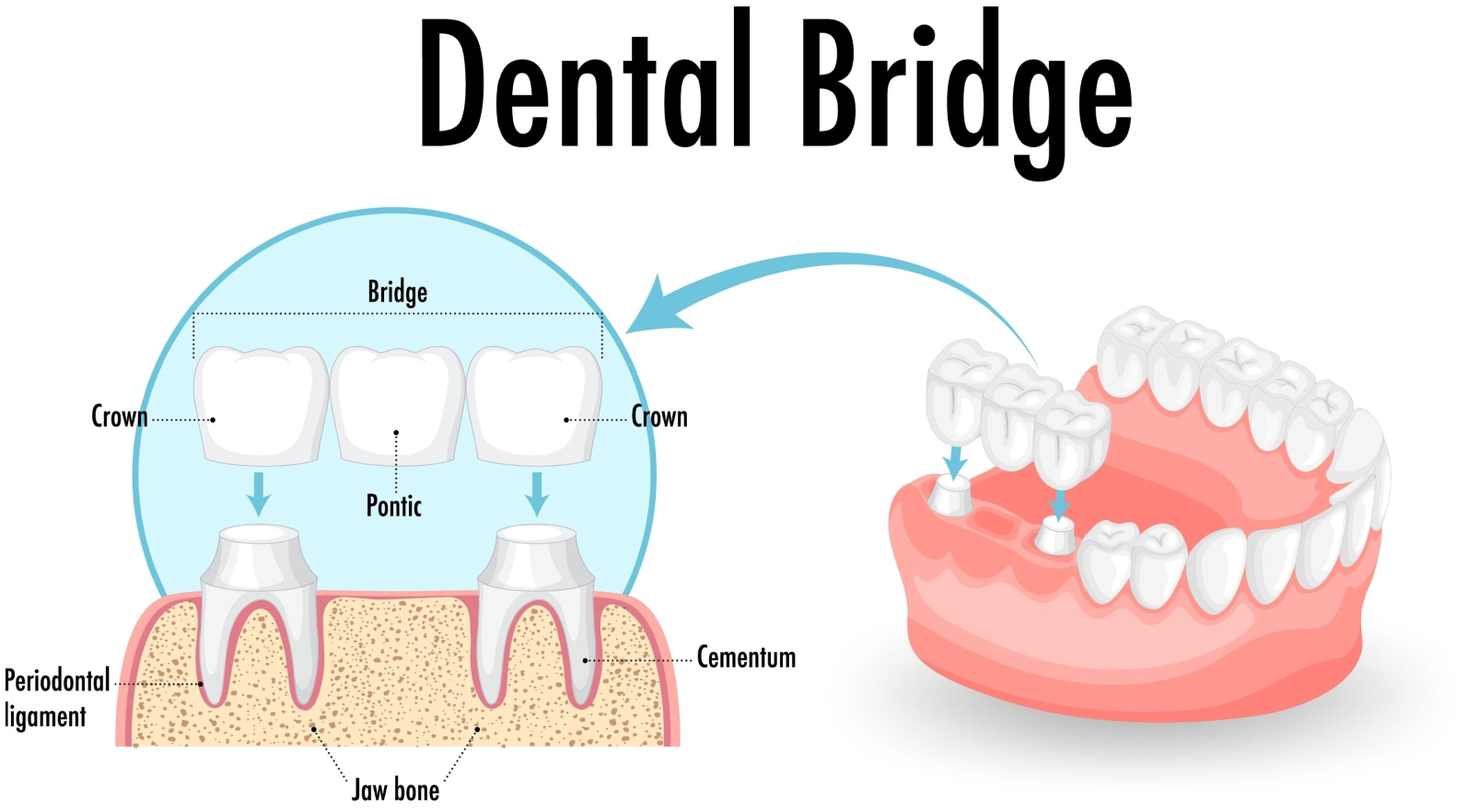 Dental Bridges Brentwood, MO | Restorative Dentistry Near Brentwood