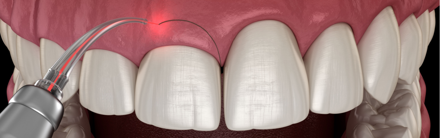 Gum Contouring in Glasgow Village, MO | Cosmetic Dentistry | Dentist Near Glasgow Village