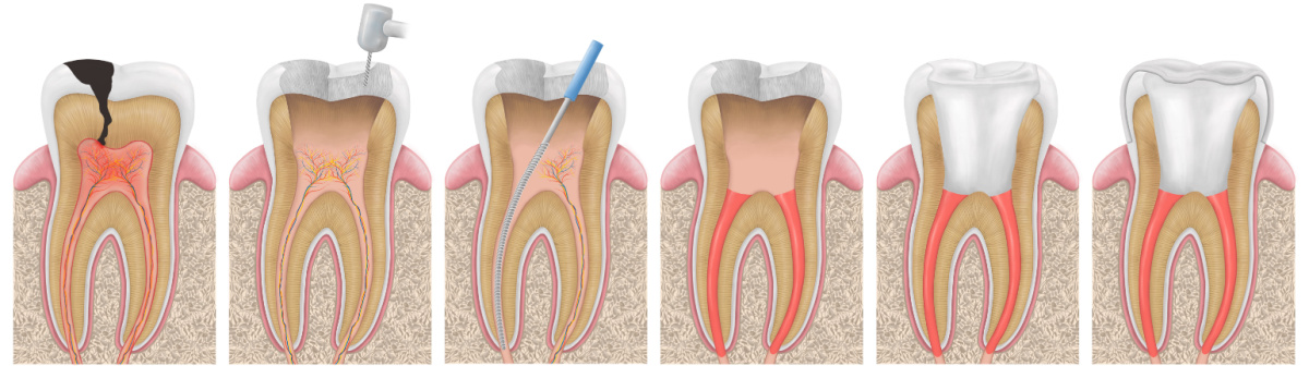 Root Canal Therapy in St. Louis | Endodontic Treatment | Dentist Near Me